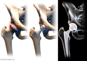 Advantages of Avascular Necrosis (AVN) of the Hip Treatment: A Guide to Improved Quality of Life