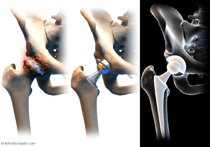 Advantages of Avascular Necrosis (AVN) of the Hip Treatment