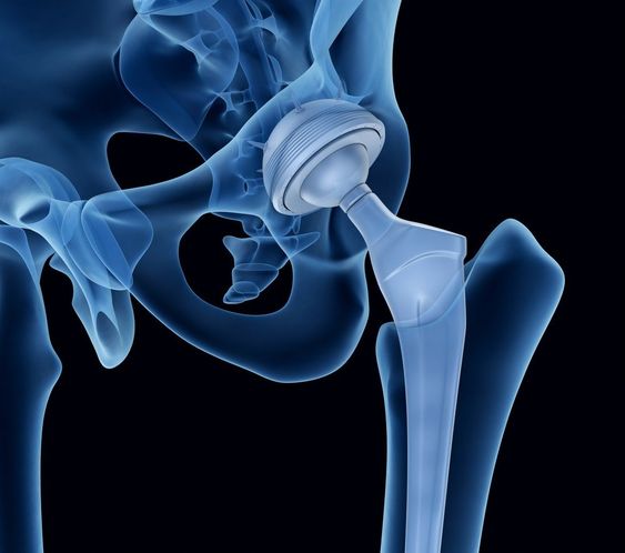 Stages of Avascular Necrosis (AVN) of the Hip