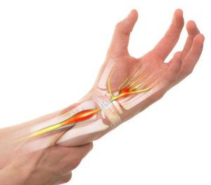 6 Facts About Carpal Tunnel Syndrome You Should Know