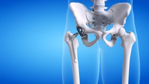 5 Signs You Need a Hip Replacement