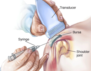 What is Ultrasound Guidance?