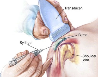 Ultrasound Guidance in Medical Procedure