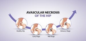 5 Major Causes of Avascular Necrosis (AVN) of the Hip