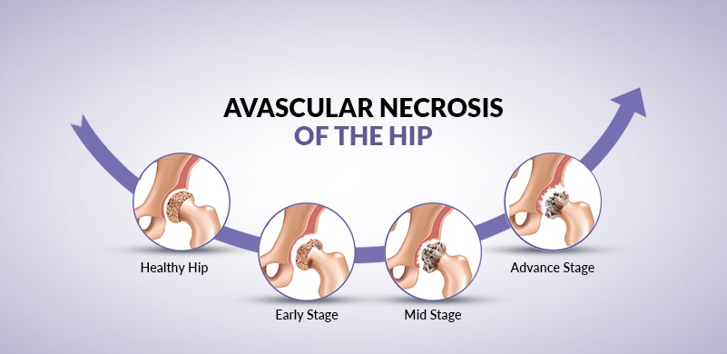 Stages of Avascular Necrosis (AVN) of the Hip