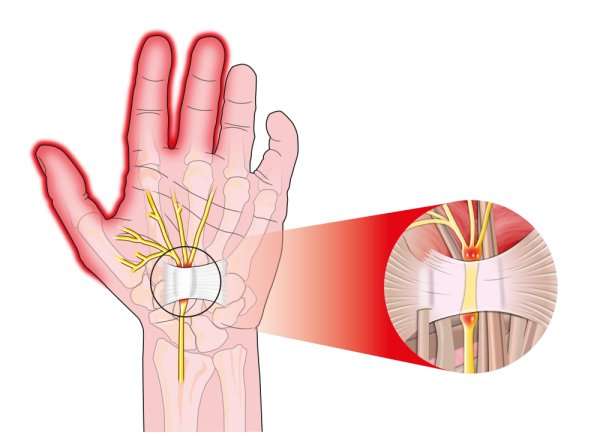 A doctor examining a patient's wrist for Carpal Tunnel Syndrome symptoms.