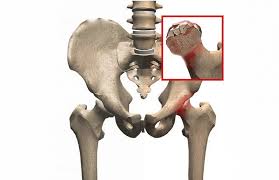 A doctor reviewing an X-ray of a hip affected by Avascular Necrosis (AVN).