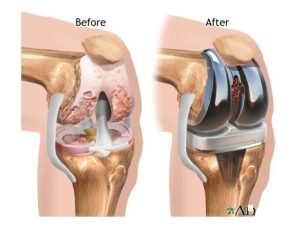 The Integral Role of Physiotherapy in Total Knee Replacement Recovery