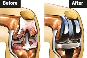 Knee Joint Preservation: Why and How It’s Done