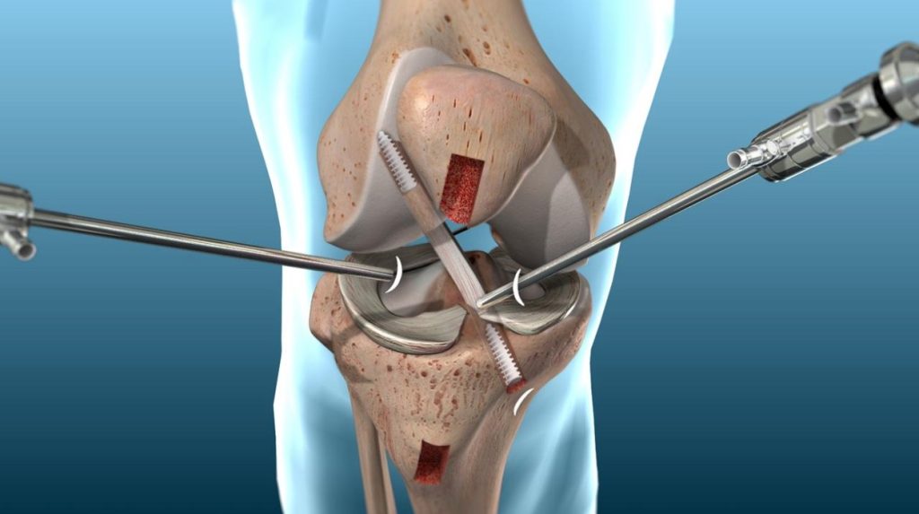 ACL Reconstruction Surgery