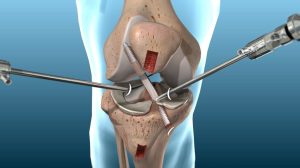 ACL Reconstruction: What You Need to Know