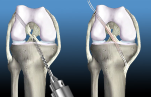 The Ultimate Guide to ACL Reconstruction