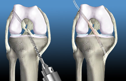 ACL Reconstruction