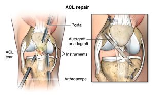 Recovering from Anterior Cruciate Ligament Repair