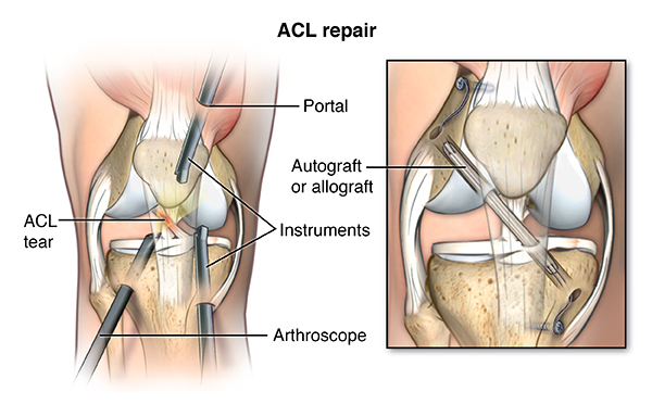 Anterior Cruciate Ligament Repair Recovery