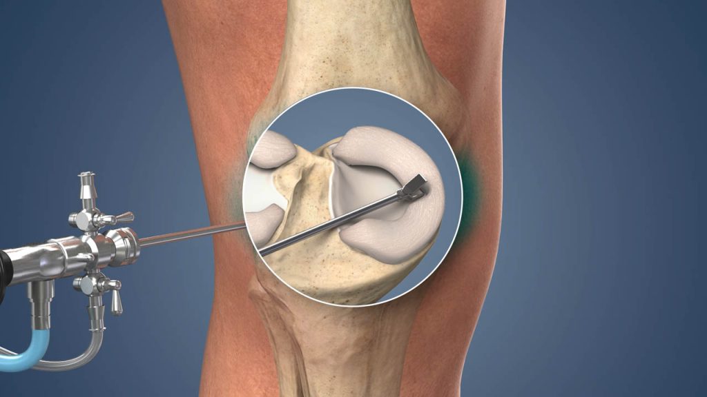 Arthroscopy Surgery