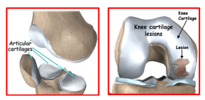 Understanding Articular Cartilage Injuries: Causes, Treatments, and Recovery