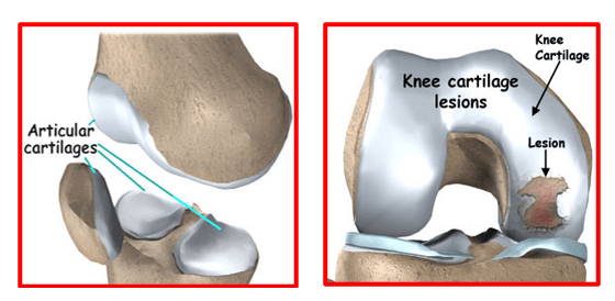 Articular Cartilage Injuries