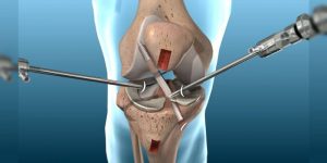 Knee Arthroscopy: How It Can Help You