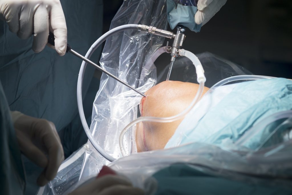 Knee Arthroscopy