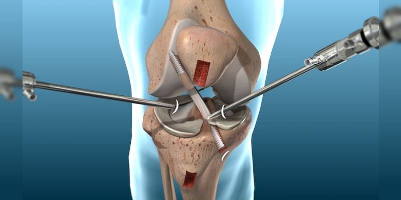 Knee Arthroscopy