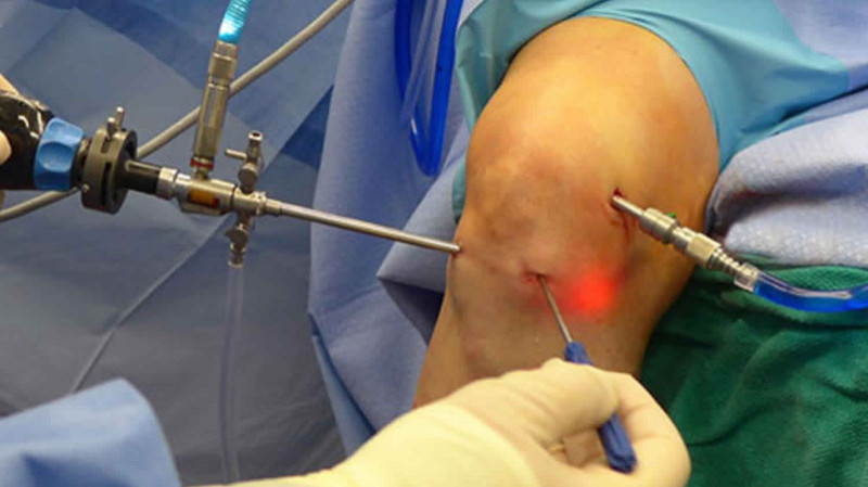 Knee Arthroscopy Surgery in Gorakhpur