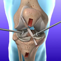 ACL Surgery in Gorakhpur