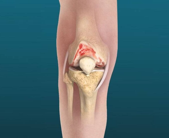 Knee Treatment in Gorakhpur