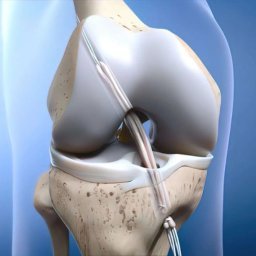 ACL Surgery in Deoria