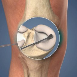 Knee Arthroscopy in Deoria