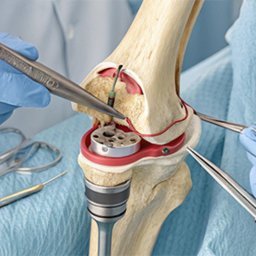 Robotic Knee Surgery in Deoria