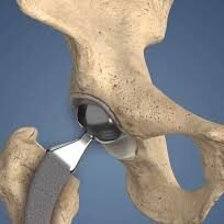 Hip Replacement in Patna