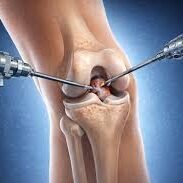 Knee Arthroscopy in Patna