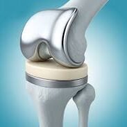 Knee Replacement in Patna